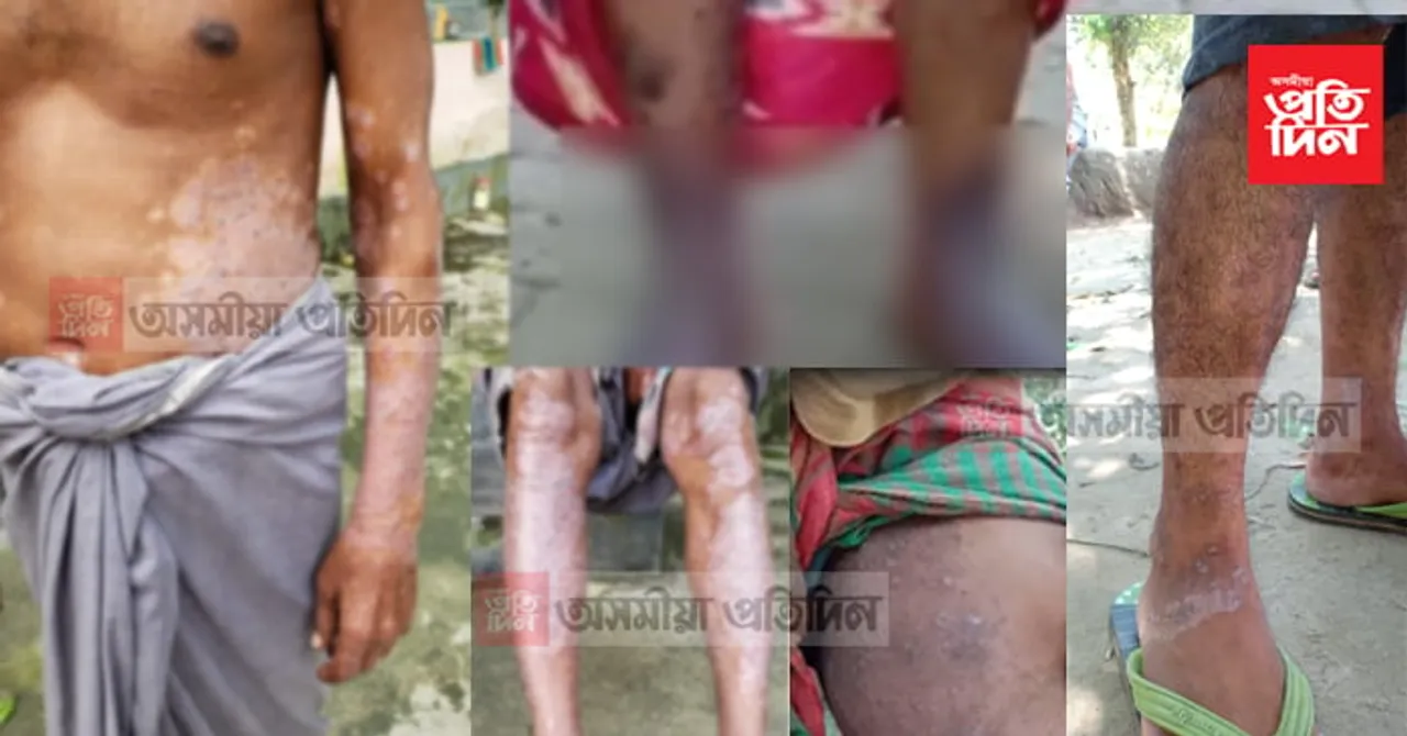 কেনেকৈ বিয়পিছে এই অচিন ৰোগ, আপুনিও হওক সাৱধান, ৰক্ষা কৰক আপোনজনক শেষ হোৱাৰ পৰা