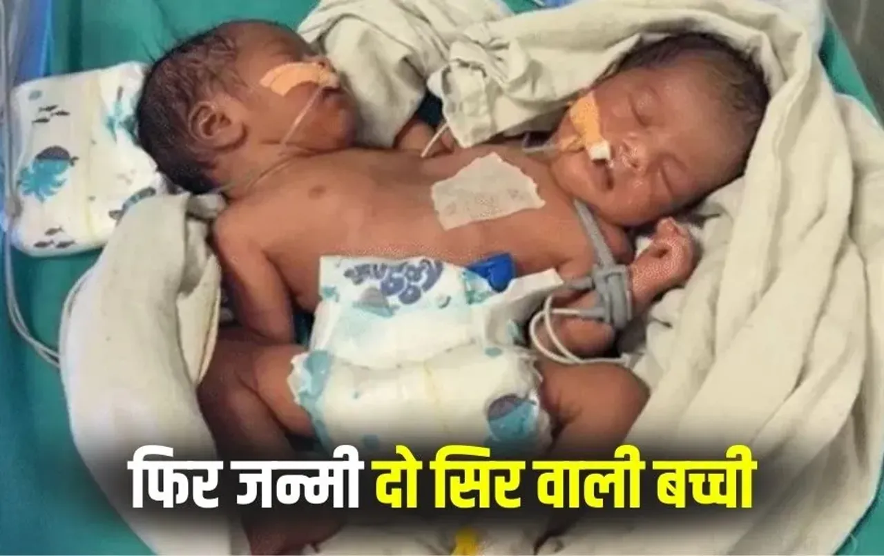 Indore Conjoined Twins