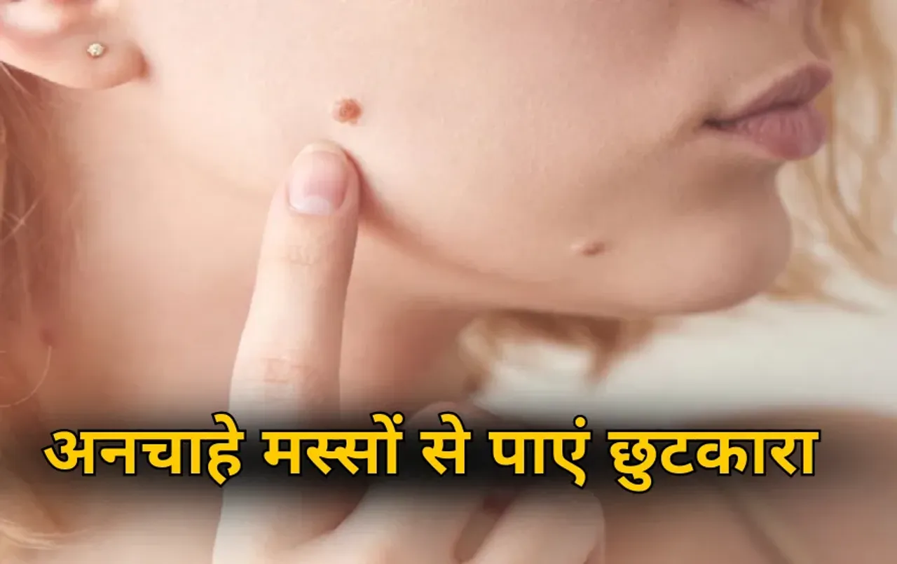 Moles Removal Tips: शरीर पर अनचाहे मस्सों से हैं परेशान? इन आसान घरेलू नुस्खों से रातों-रात पाएं छुटकारा