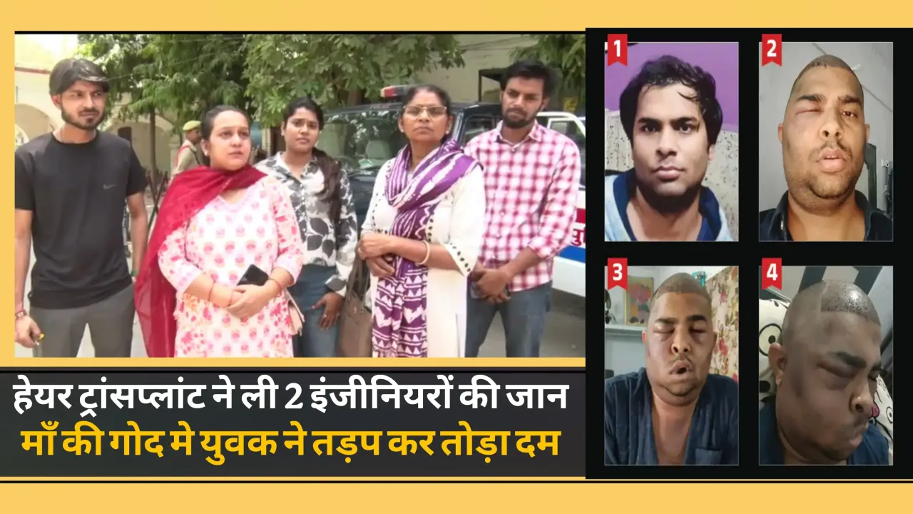 Hair Transplant Death Case: हेयर ट्रांसप्लांट के बाद एक और इंजीनियर की मौत, डॉक्टर अनुष्का तिवारी पर लापरवाही के आरोप