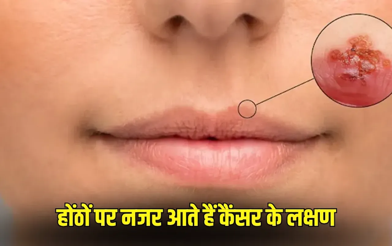 Lip Cancer Symptoms: होंठों पर दिखें ये 5 लक्षण तो तुरंत जाएं डॉक्टर के पास, नजरअंदाज करने से बढ़ सकती है परेशानी