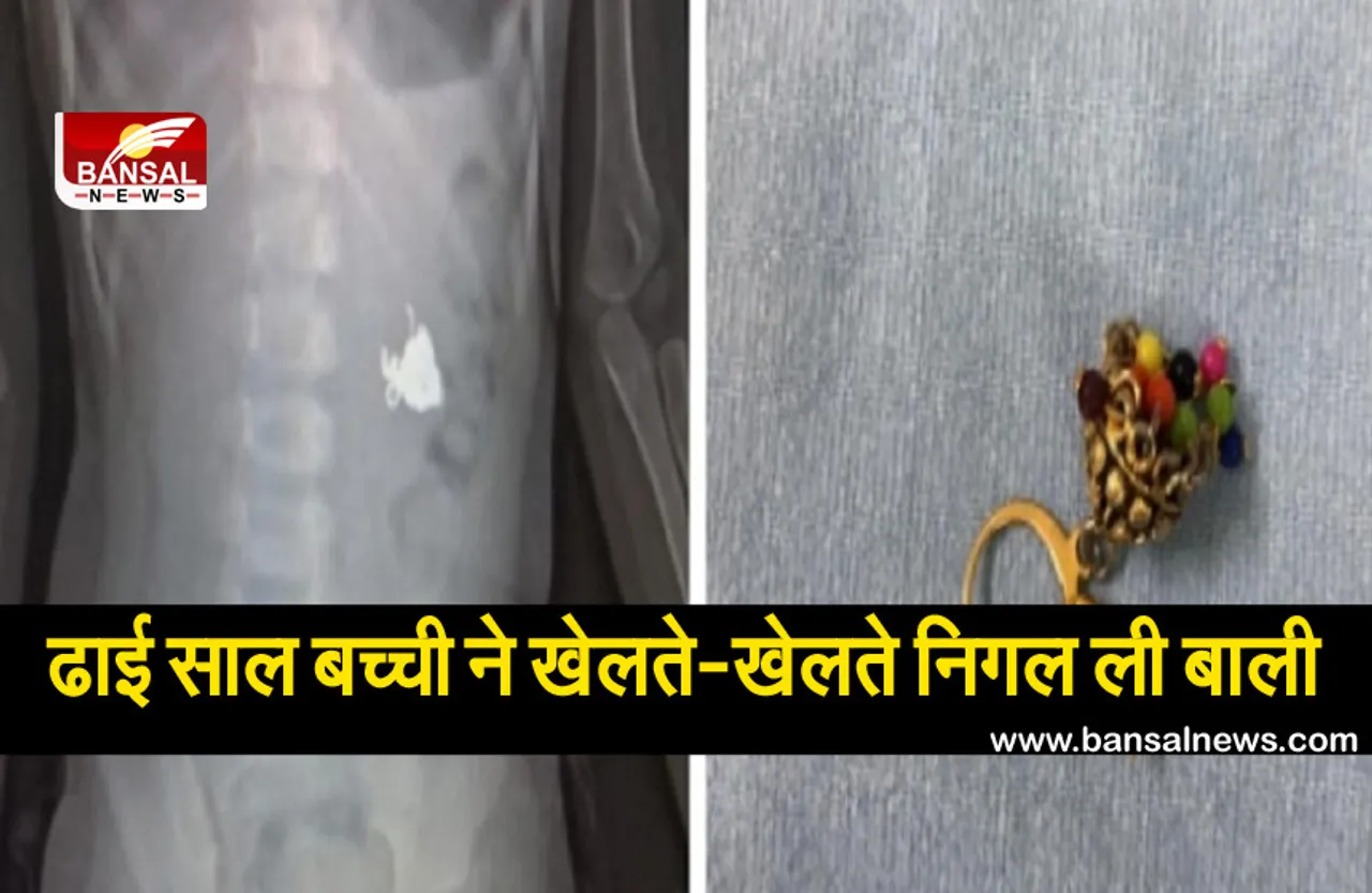 ढाई साल बच्ची ने खेलते-खेलते निगल ली मां के कान की बाली, फिर हुआ ये....