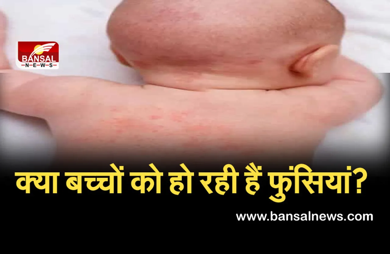 Eczema Symptoms: बच्चों के शरीर पर दिखे फुंसियां, तो ना करें नजरअंदास, हो सकती है बीमारी