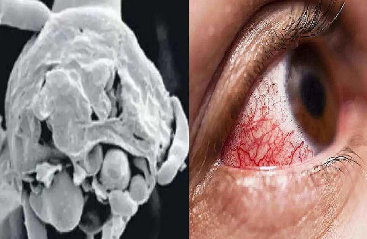 प्रदेश में व्हाइट फंगस के दो मरीज, जबलपुर व ग्वालियर में आए केस