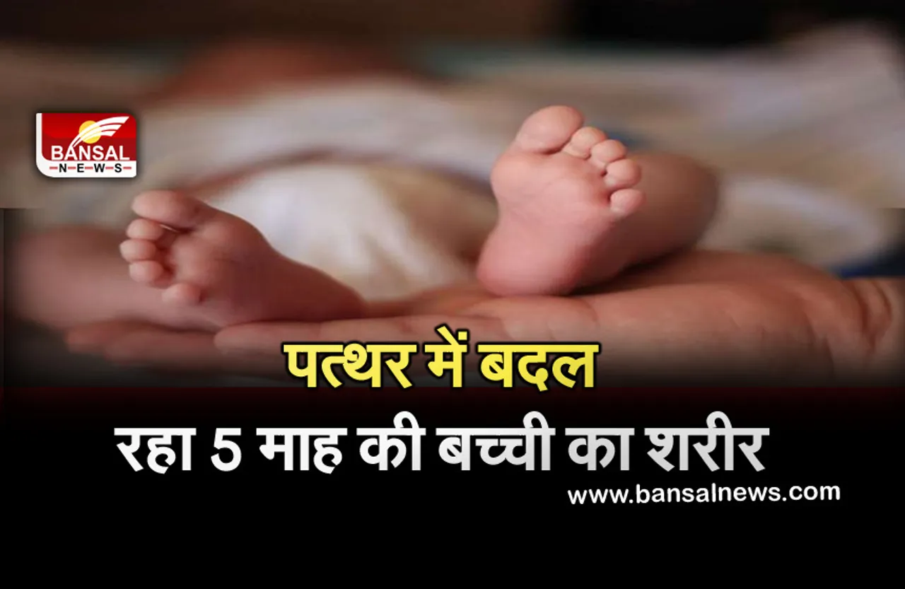 Ajab-Gajab News: घातक बीमारी की चपेट में आई 5 महीने की बच्ची, धीरे-धीरे पत्थर में बदल रहा शरीर