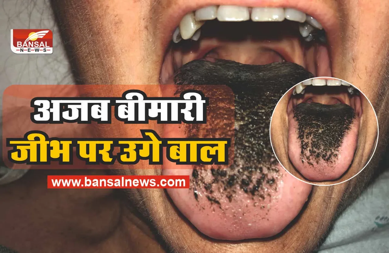 Black Hairy Tongue Syndrome : इस सख्स की जीभ पर उगते है बाल, हैरान कर देने वाला मामला