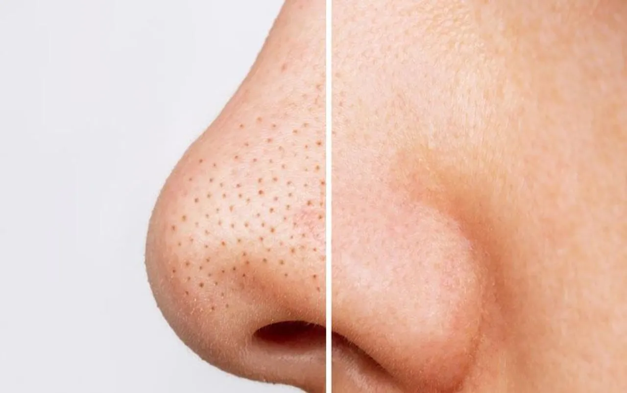 Blackheads Remedies: ब्लैकहेड्स से हैं परेशान हैं, तो ये 4 घरेलू चीजें आज ही स्किन केयर रूटीन में शामिल करें