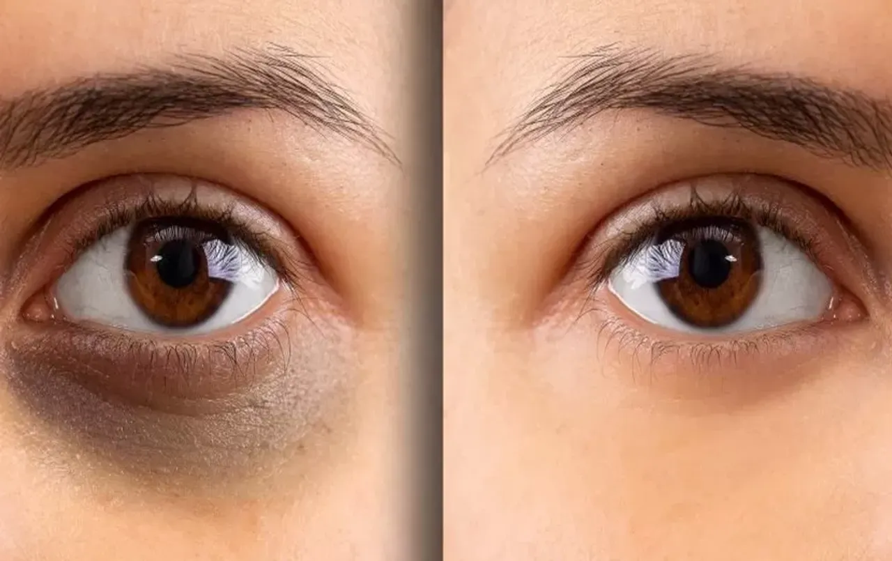 Dark Circles Removal Tips: घरेलू नुस्खे के सामने महंगी-महंगी क्रीम हो जाएंगी फ़ैल, 1 महीने में डार्क सर्कल्स होंगे खत्म