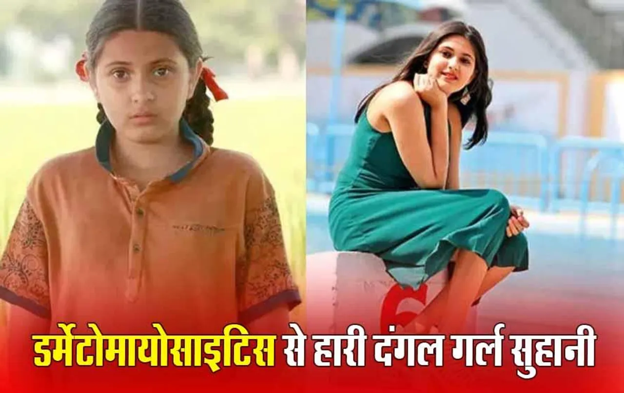 क्या है Dermatomyositis, जिसने ली दंगल गर्ल सुहानी की जान; जानिए कम उम्र में होने वाली इस बीमारी के लक्षण और बचाव