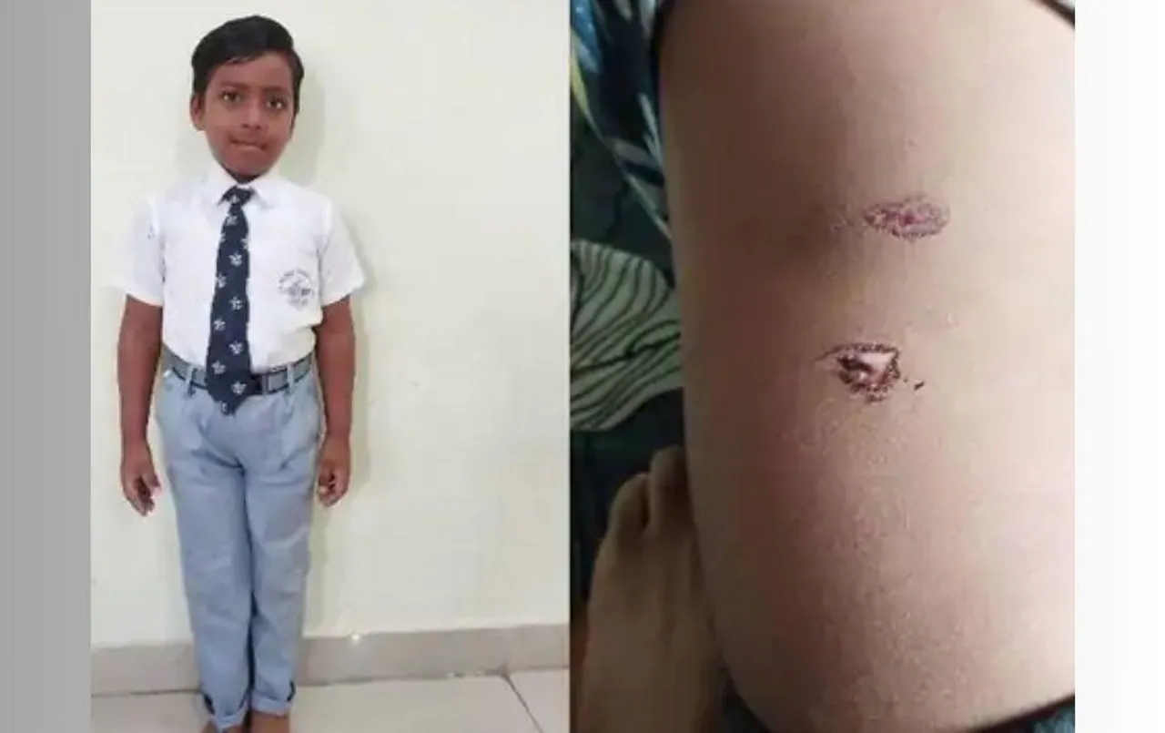 भोपाल में मासूम पर कुत्तों का हमला: नीलबड़ में स्ट्रीट डॉग ने बच्चे के पेट-कमर पर काटा, जेपी हॉस्पिटल में भर्ती