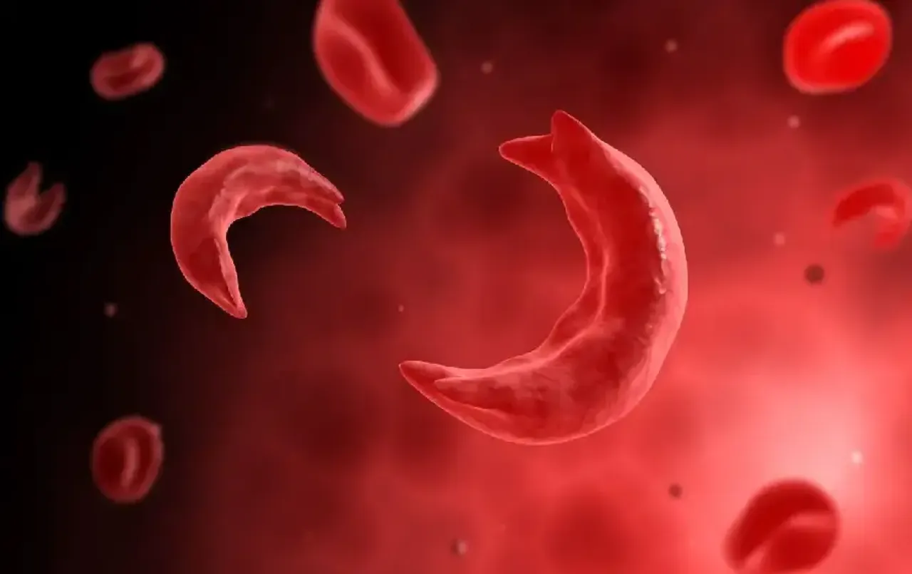 World Sickle Cell Day: Genetic Disease क्‍या है?  ये कैसे होती है, जानें इसके लक्षण और ये क्‍यों होती है