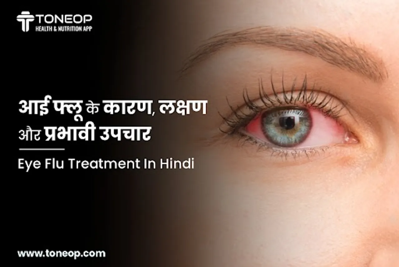 आई फ्लू के कारण, लक्षण और प्रभावी उपचार/Eye Flu Treatment In Hindi