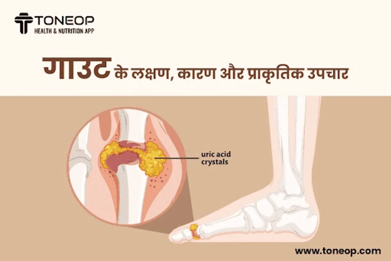 गाउट के लक्षण, कारण और प्राकृतिक उपचार