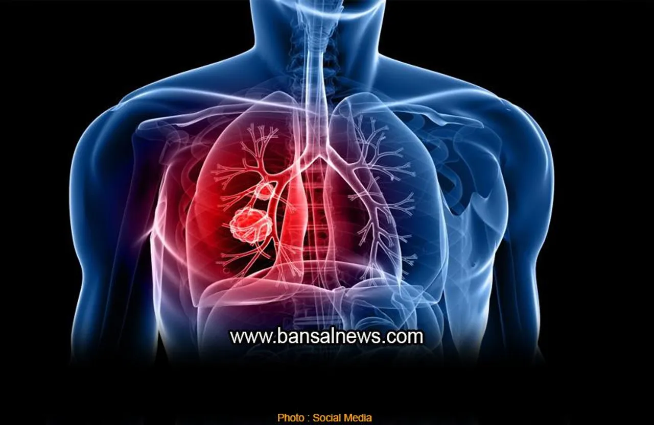 Lung Cancer : नोबेल पुरस्कार विजेता ने बताया फेफड़े के कैंसर से लड़ने के लिए नई पद्धतियां है कारगर