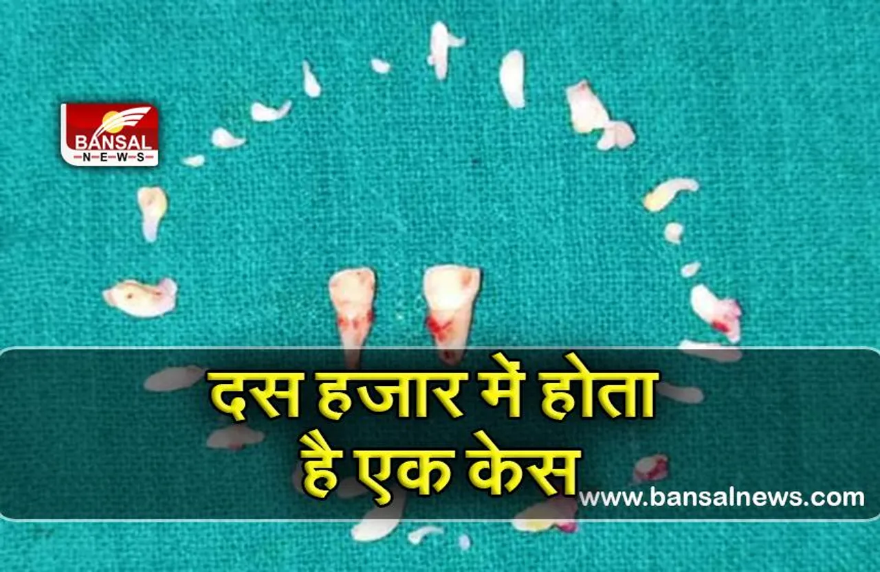 अनोखा केस: 10 साल के बच्चे के 50 दांत, डॉक्टरों ने सर्जरी कर 30 दांत निकाले