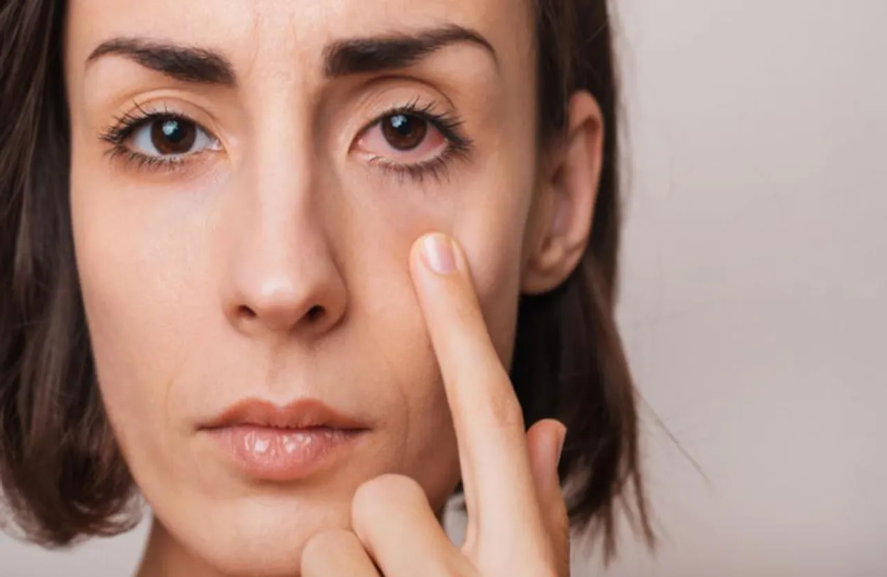 EYE FLU FACT: क्या विटामिन डी का आई फ्लू से कोई है कनेक्शन, जानिए आंसू पर की गई स्टडी