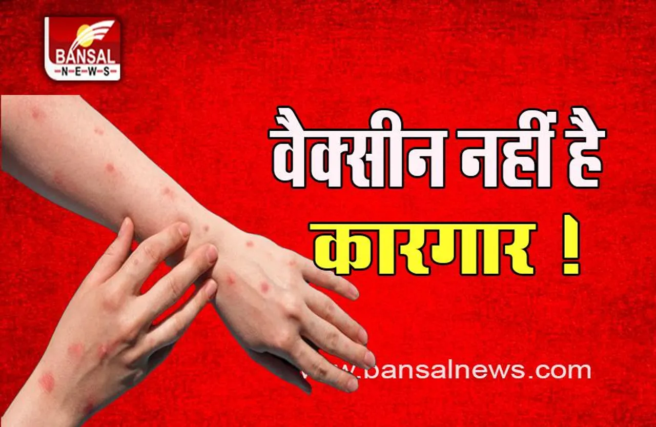 Monkeypox Big Breaking: हो जाइए सतर्क ! वायरस की नहीं है कोई 100 % प्रभावी वैक्सीन, पढ़ें WHO के आंकड़ें