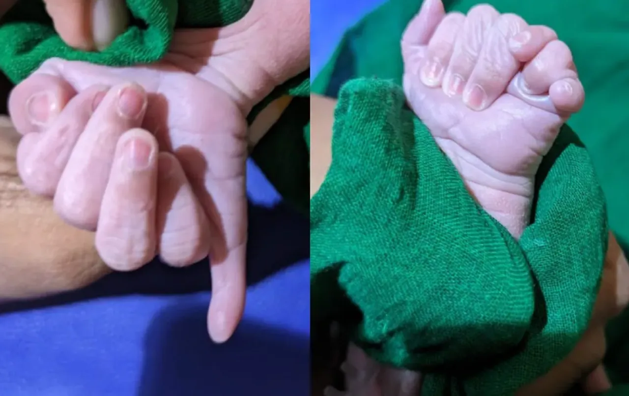 सावन के पहले हुआ 25 अंगुलियों के साथ बच्‍चे का जन्‍म: परिवार वालों ने बताया देवी का आशीर्वाद, इस राज्‍य से आया मामला