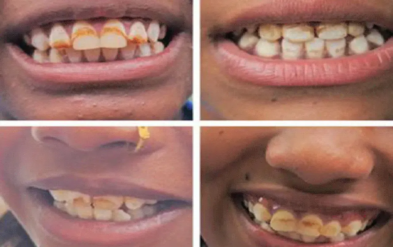 CG High Court Notice: छत्‍तीसगढ़ के 40 गांवों में इस गंभीर बीमारी से ग्रसित लोग, हाईकोर्ट ने सरकार से मांगा जवाब