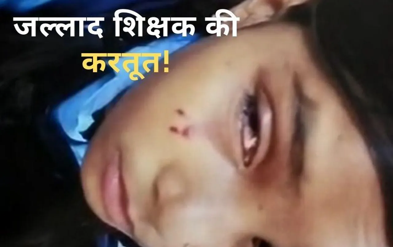 छत्तीसगढ़ में शिक्षक ने बच्चों को बेरहम से पीटा: 5वीं की छात्रा बुरी तरह जख्मी, आंख में चोट आने से रेटिना में खून जमा