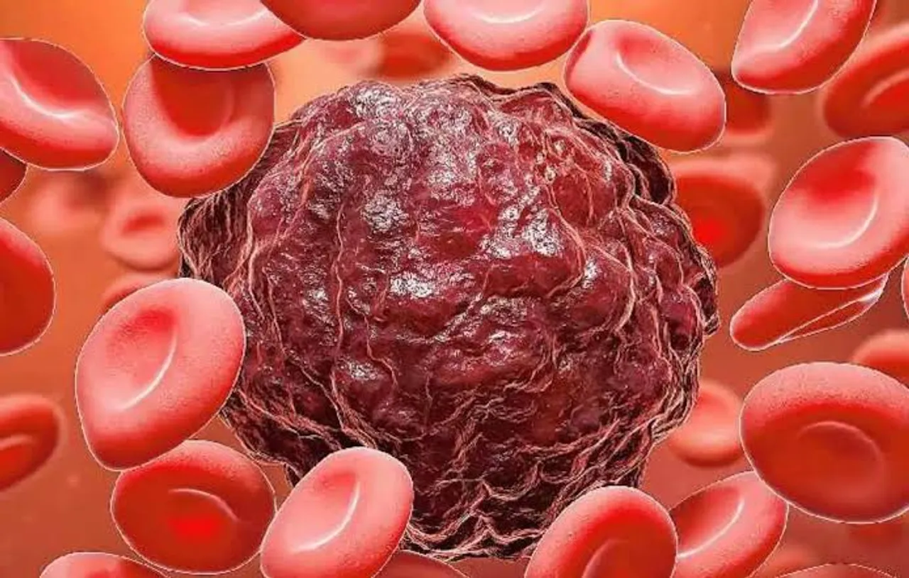 Study: Cancers in head and neck rising, account for 26% cases in India