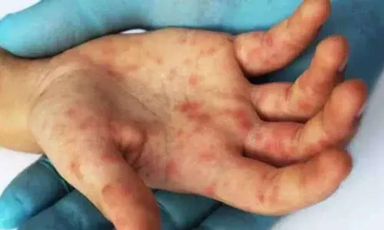 Centre issues advisory to states on Tomato Flu
