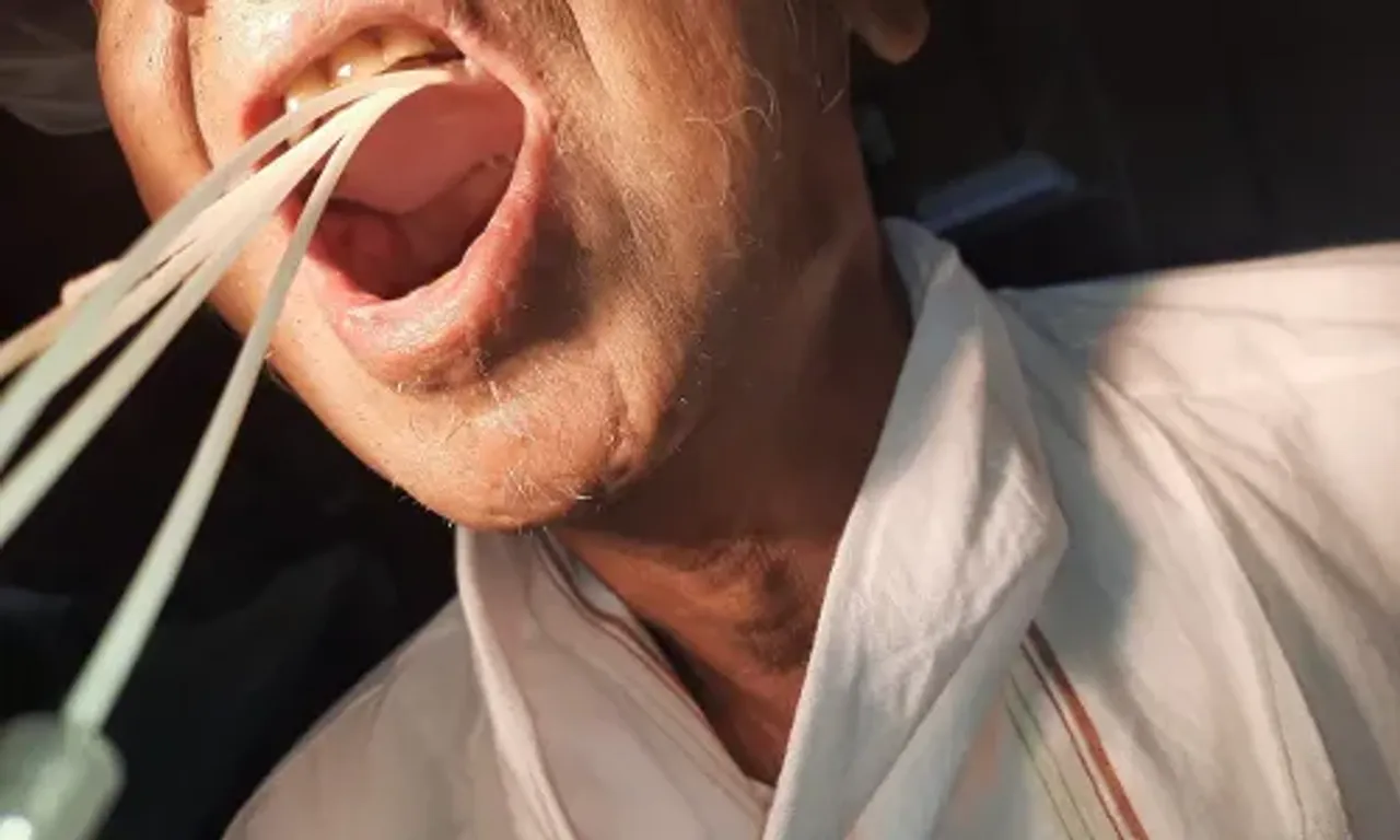 Radiation oncology department of Sayaji Hospital with dental department successfully treated cancerous ulcer of the palate