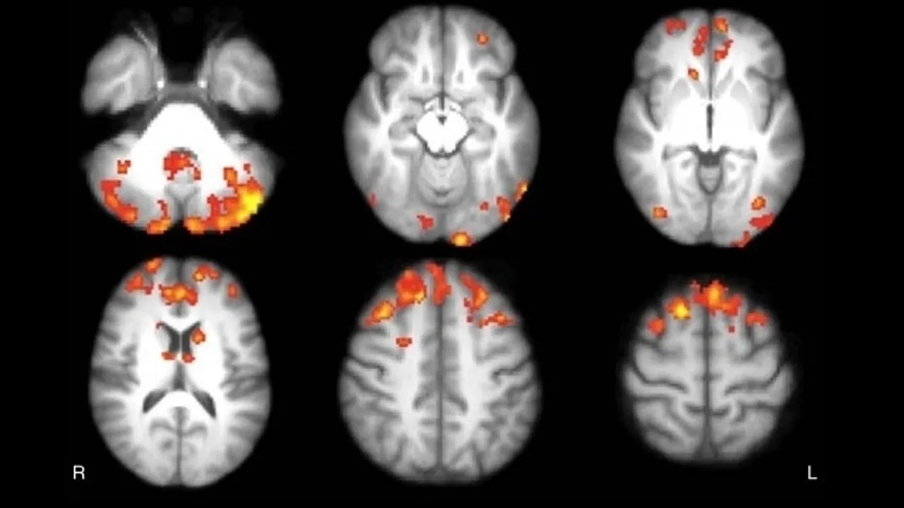Computer programme beats doctors at spotting brain cancer