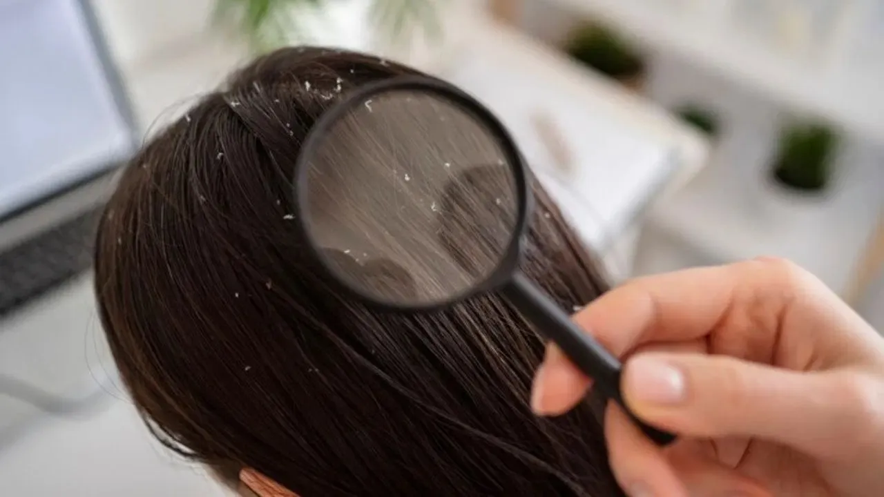 DANDRUFF