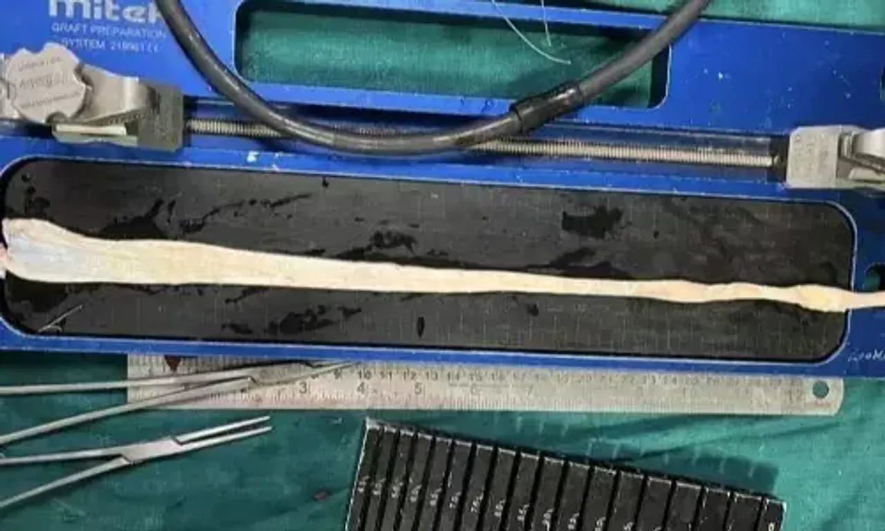 વડોદરા: SSG હોસ્પિટલમાં નિષ્ણાત દ્વારા એલોગ્રાફટ થકી ઘૂંટણના સ્નાયુનું સફળ ઓપરેશ પાર પડાયુ