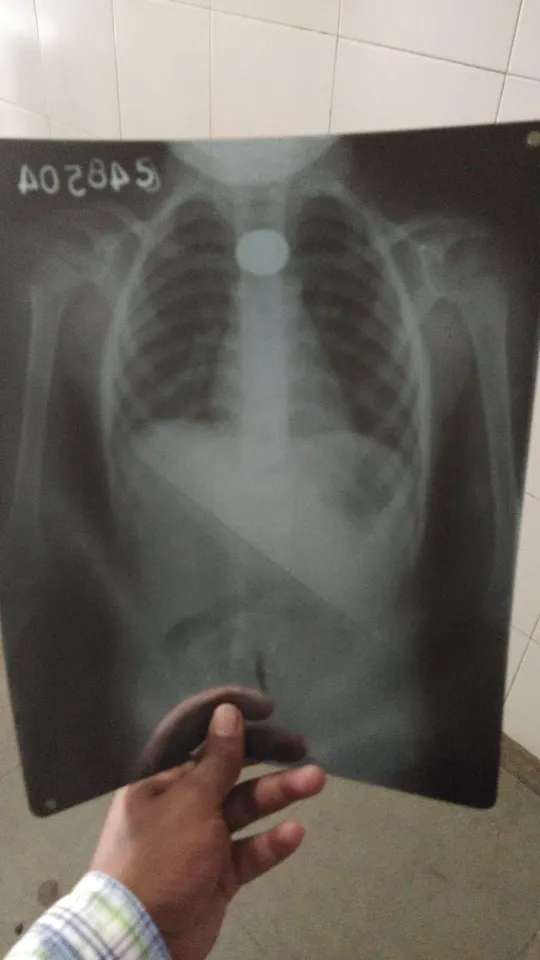 સુરતઃ 4 વર્ષનો બાળક સિક્કો ગળી જતાં થઈ દોડધામ, સિવિલ હોસ્પિટલમાં ન મળી સારવાર