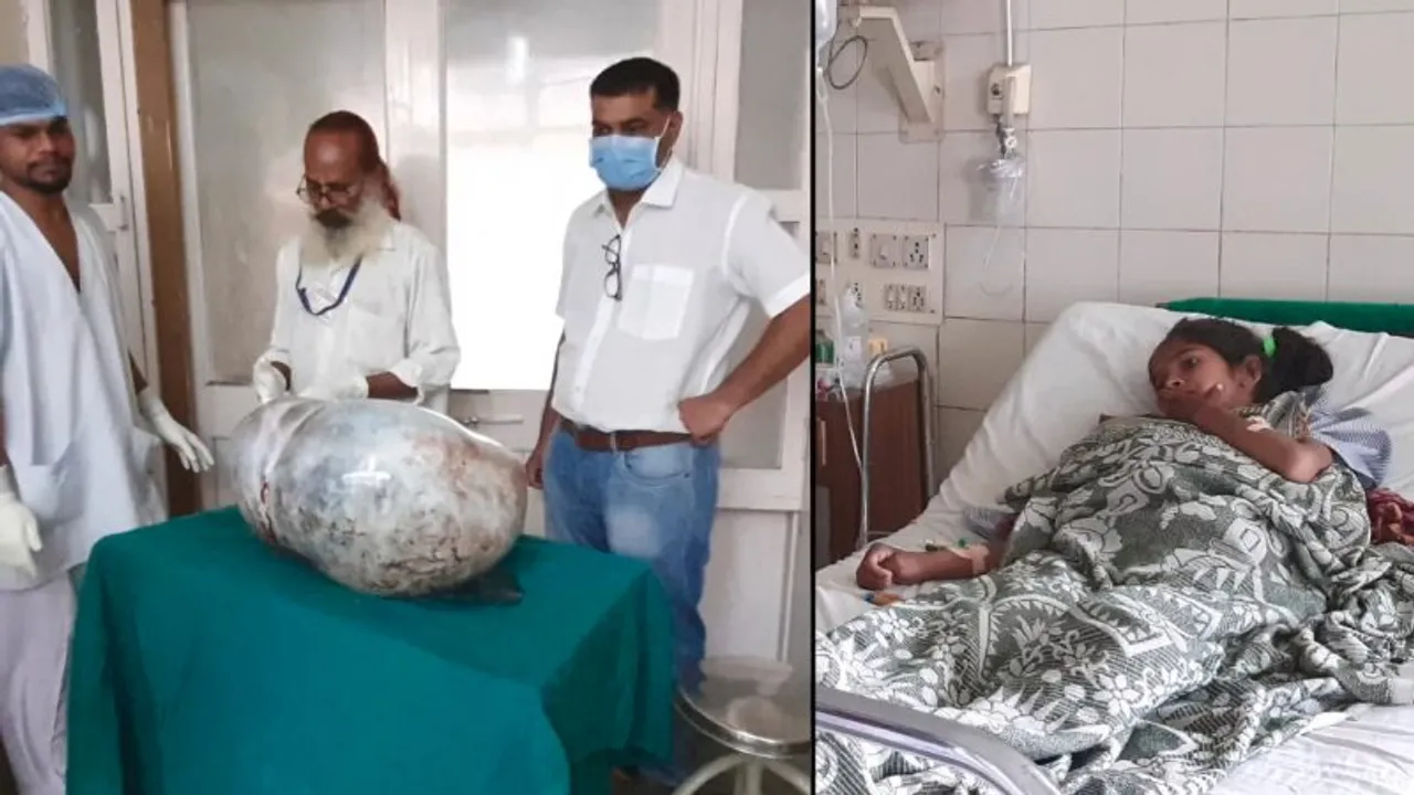દાહોદ : 14 વર્ષની કિશોરીના પેટમાંથી તબીબોએ ઓપરેશન કરી 20 કિલોની ગાંઠ કાઢી
