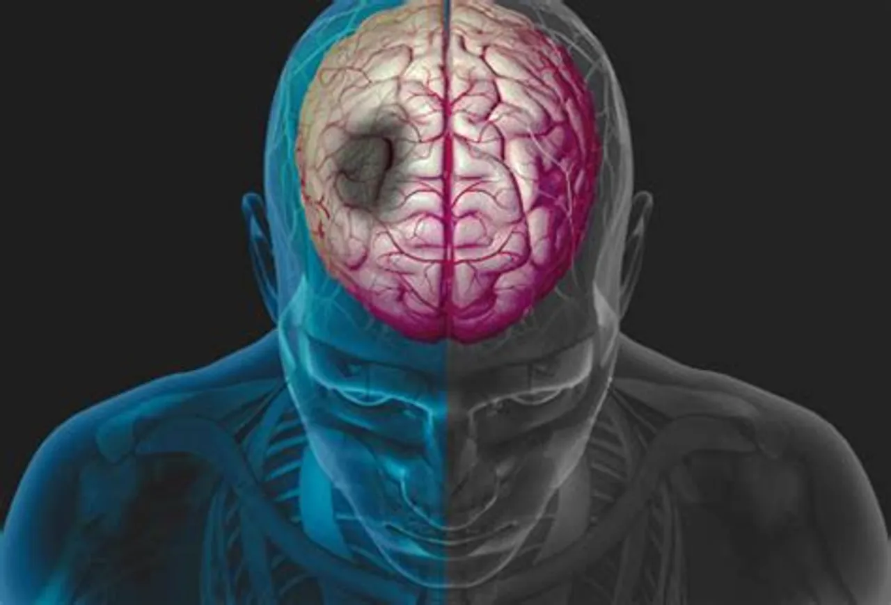 habits increasing brain stroke emergency
