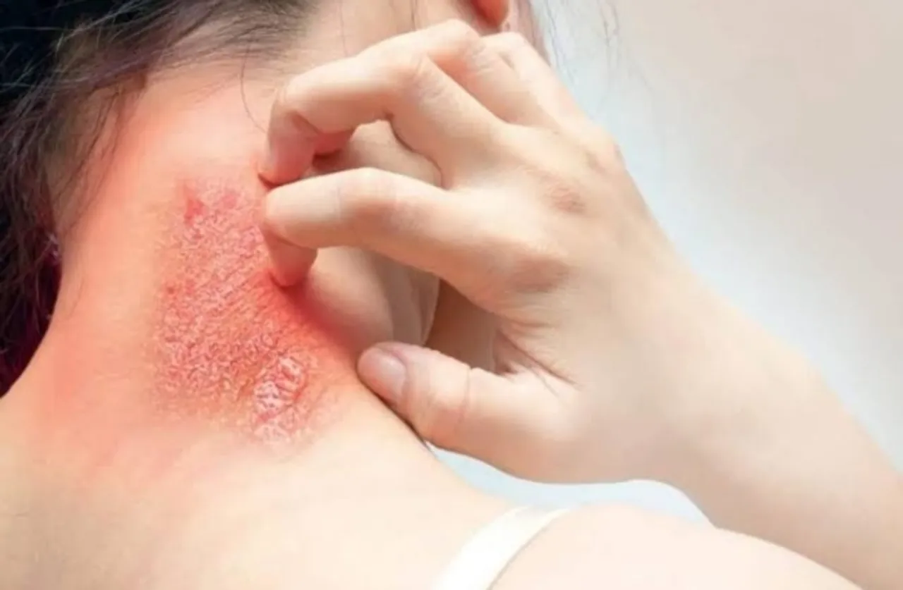 Fungal infections