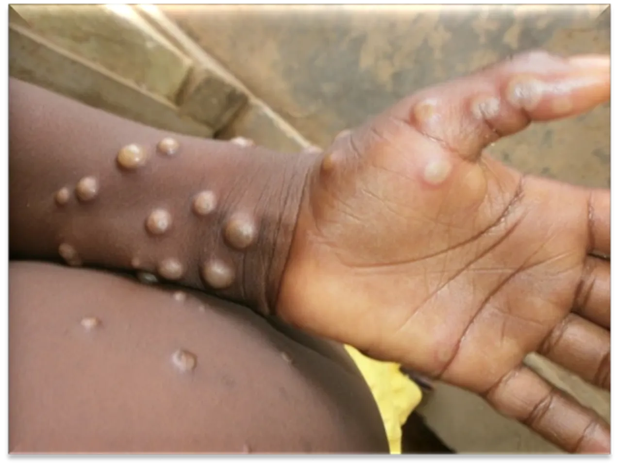 Monkeypox
