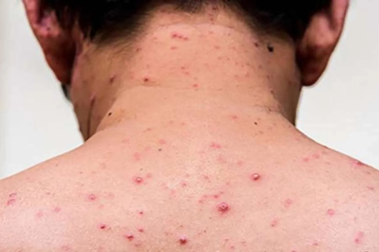 WHO on measles