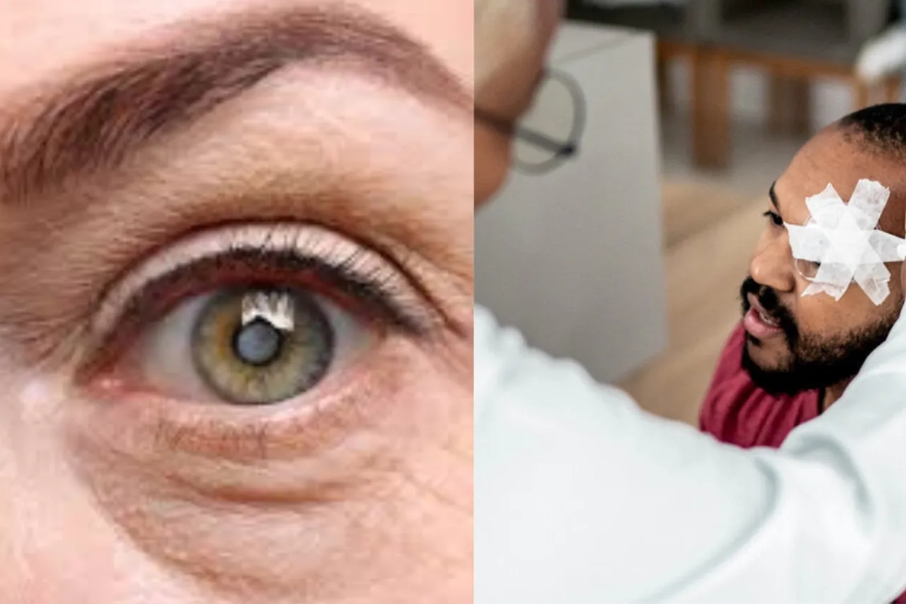Cataract