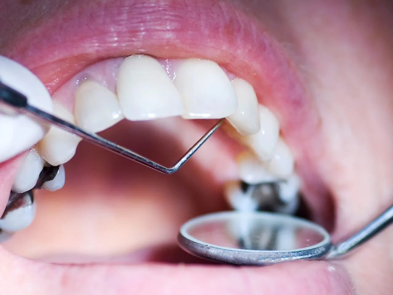Cavity in teeth