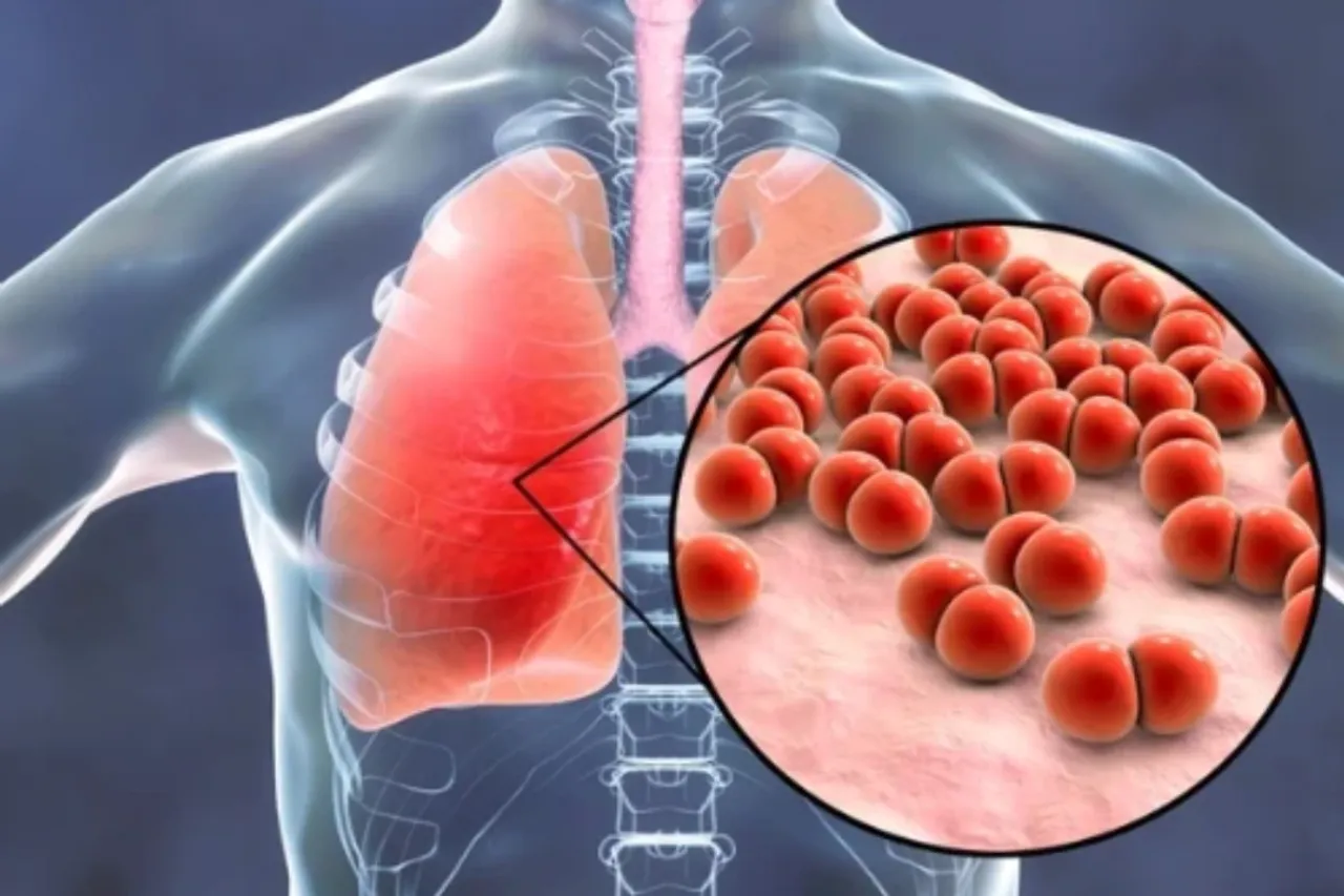 Pneumonia