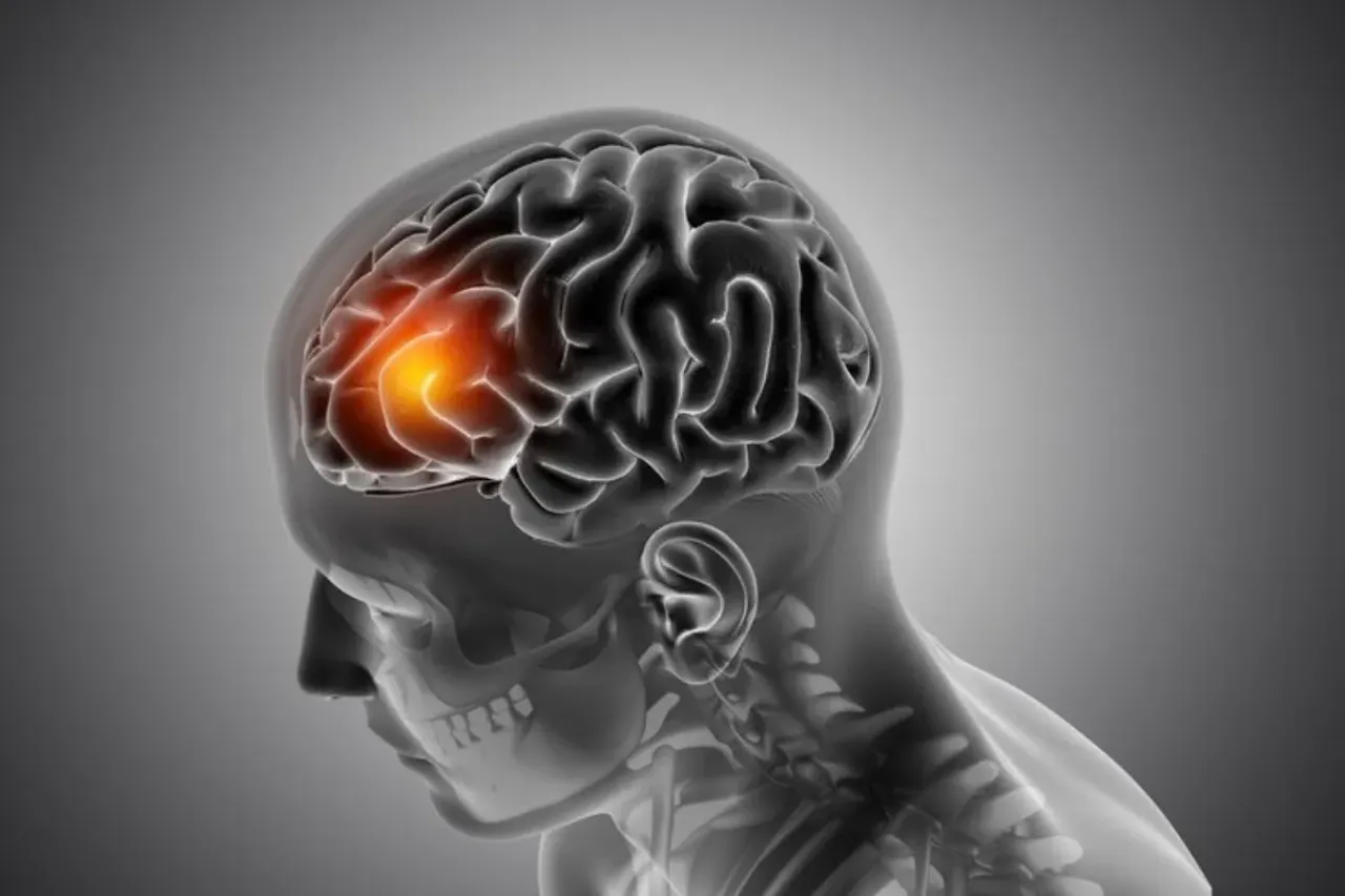 Brain Stroke