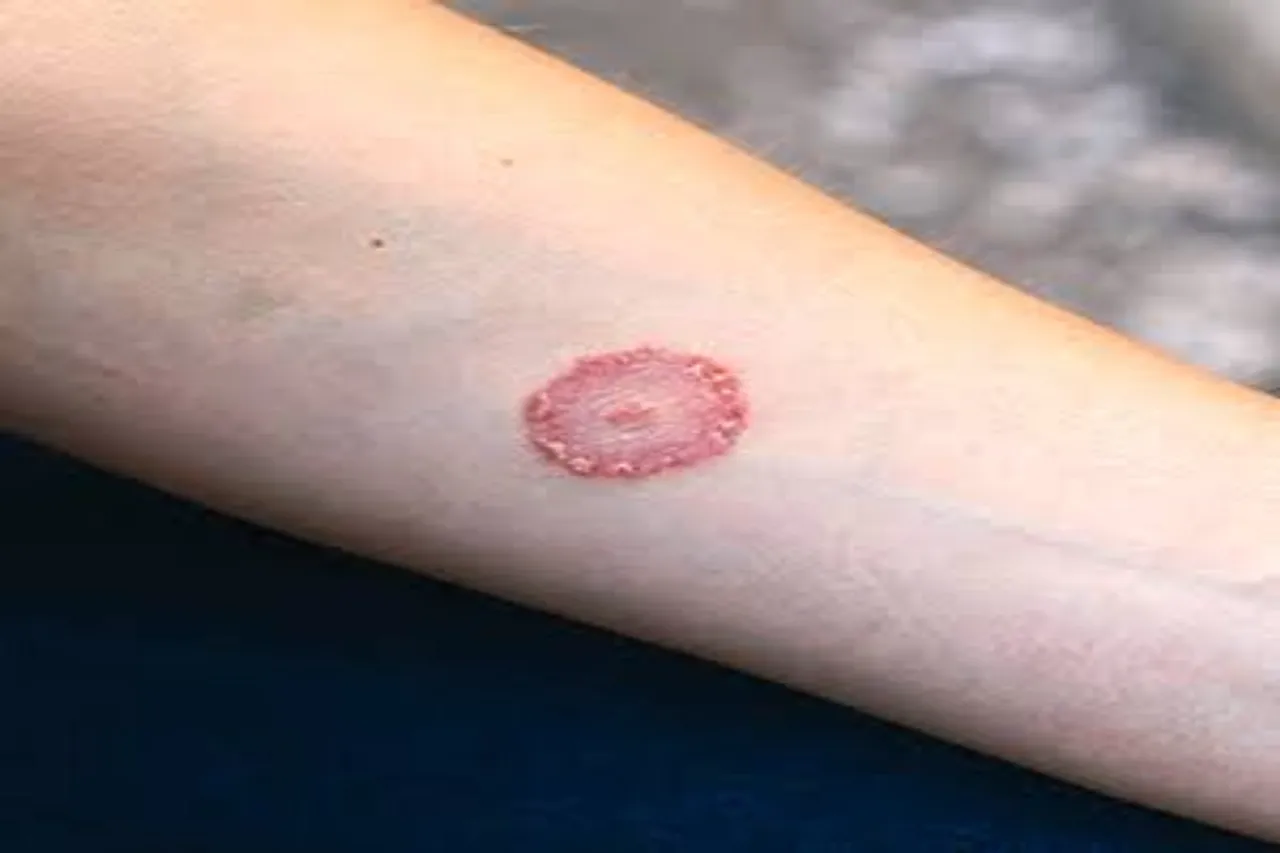 Ringworms Treatment