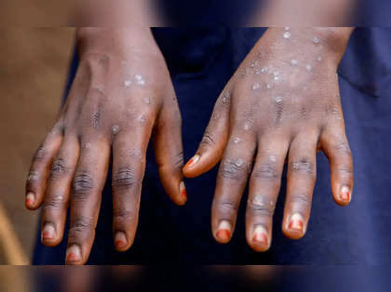 Mpox