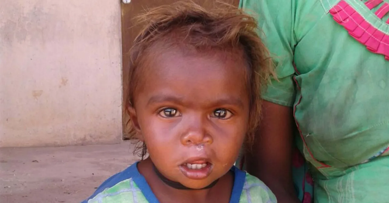 TBI Blogs: How Doctors and Support Workers Came Together to Help a 3-Year-Old Girl Born with a Cleft Lip