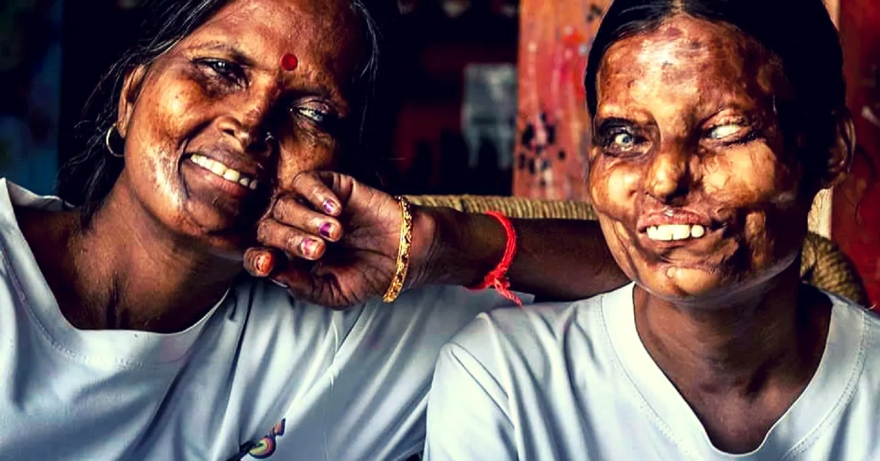 Acid Attack Survivors & Autistic Persons: A Change to India's Disability Act Will Help Even More People