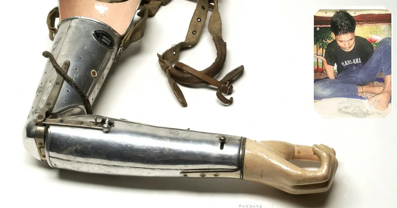 Delhi High Court Gives 16-Year-Old Foot Artist New Lease of Life With a Prosthetic Arm!