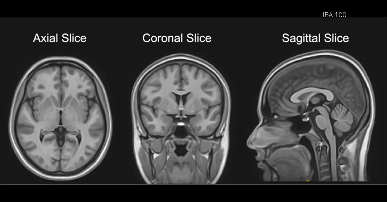 India's First Brain Atlas Created by IIIT-Hyd: A Big Step in Treating Alzheimer's, Dementia