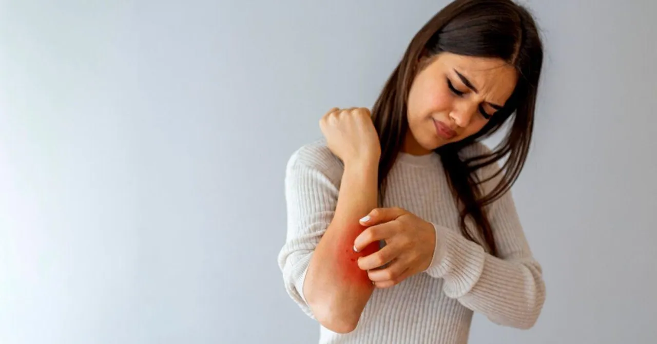 Have Eczema? Here Are the Foods to Avoid and What Will Soothe Your Skin
