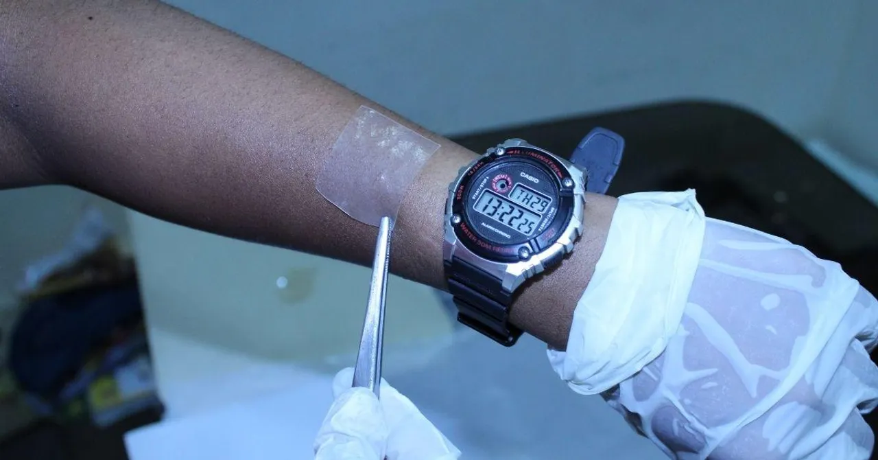 Monitor Blood Sugar Through Sweat, Using PhD Scholar's Biodegradeable Skin Patch