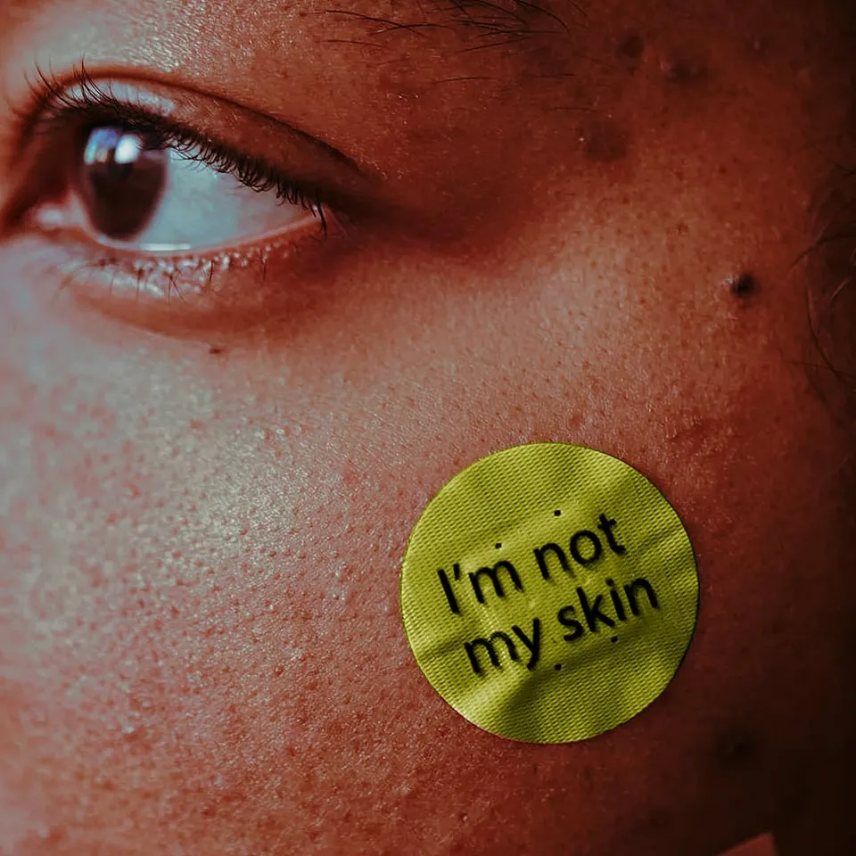 Can acne take a toll on your mental health? Experts say yes