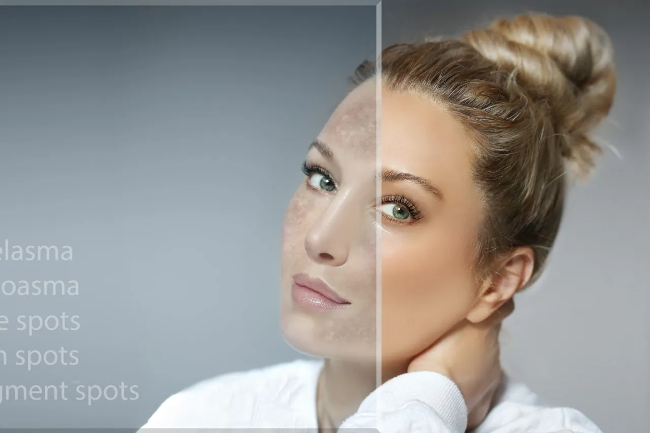Glow Right with the Perfect Pigmentation Cream for Your Skin